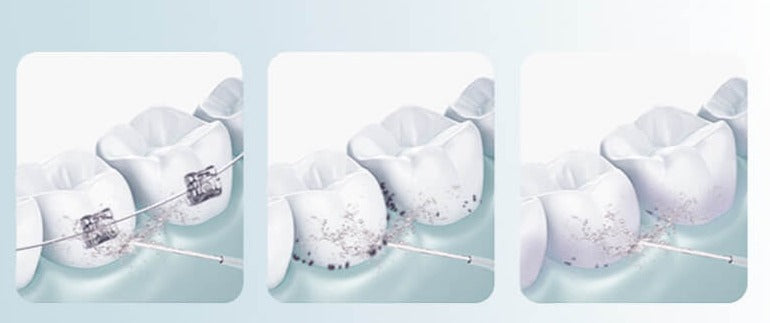 Portable Dental Water Flosser – Rechargeable, Adjustable Pressure, 5 Jet Tips