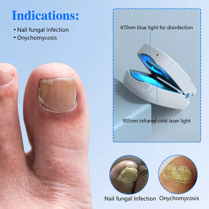 Nail Fungus Laser Treatment Device | Dual Wavelength Therapy 905nm & 470nm