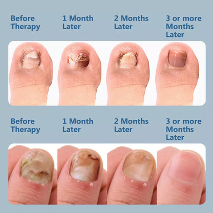 Nail Fungus Laser Treatment Device | Dual Wavelength Therapy 905nm & 470nm