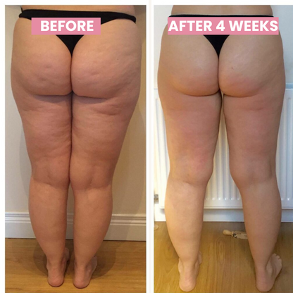 SlimCupp – Anti-Cellulite Cupping Device with Infrared Therapy